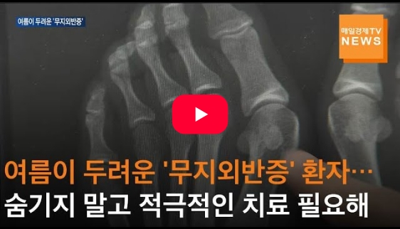 매일경제TV - 여름이 두려운 '무지외반증' 환자…숨기지 말고 적극적인 치료 필요해